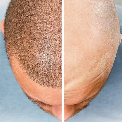 MÁQUINA DE BARBEAR 5 EM 1 PARA O CORPO, CABEÇA E BARBA - PRO PERFECT BEARD™