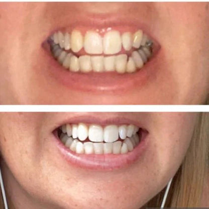 BRANQUEADOR DE DENTES COM CARVÃO ACTIVADO E EXTRACTO DE PLANTAS - WHITETH™