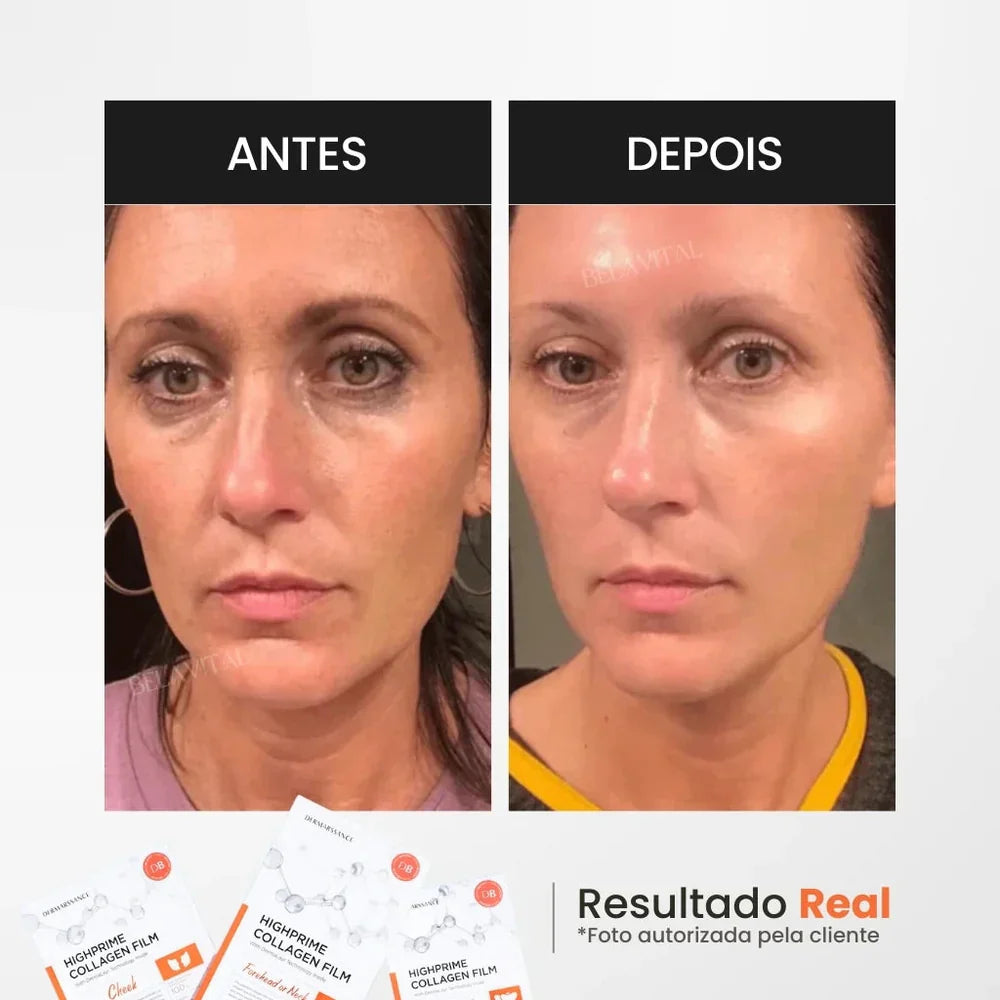 KIT GOLDBOTOX™ HIGHPRIME - COLÁGENO + ACIDO HIALURÔNICO + ATIVO DO BOTOX