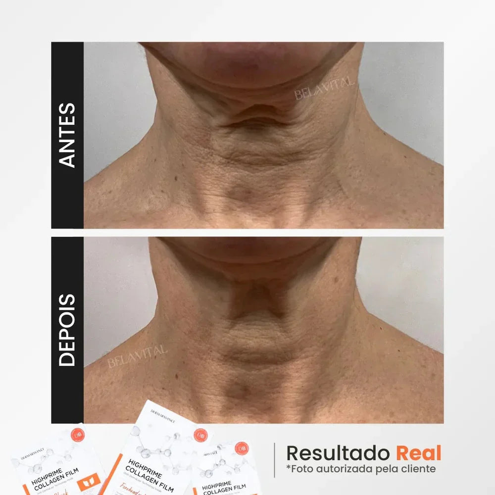 KIT GOLDBOTOX™ HIGHPRIME - COLÁGENO + ACIDO HIALURÔNICO + ATIVO DO BOTOX